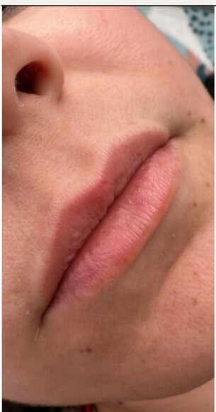 Needle-less Lips